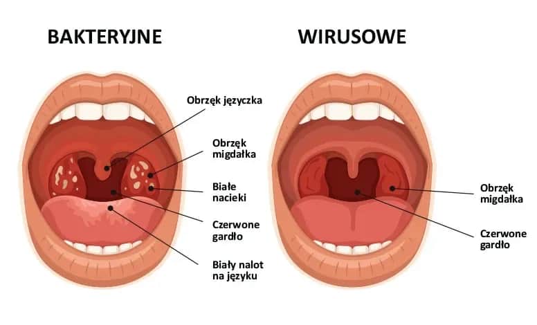 Jakie leki na anginę ropną? Skuteczne antybiotyki i porady zdrowotne