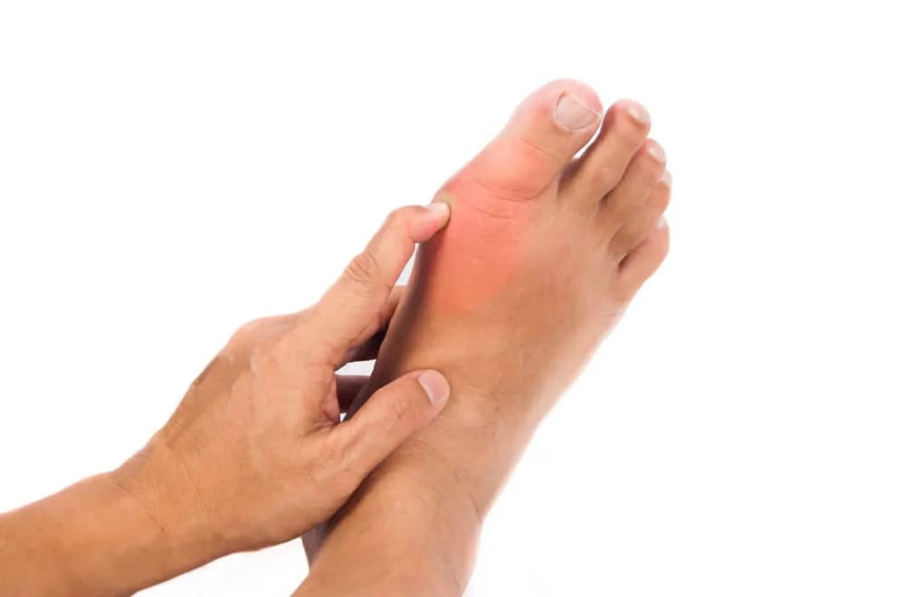 Jakie są przyczyny dny moczanowej i jak ich uniknąć?