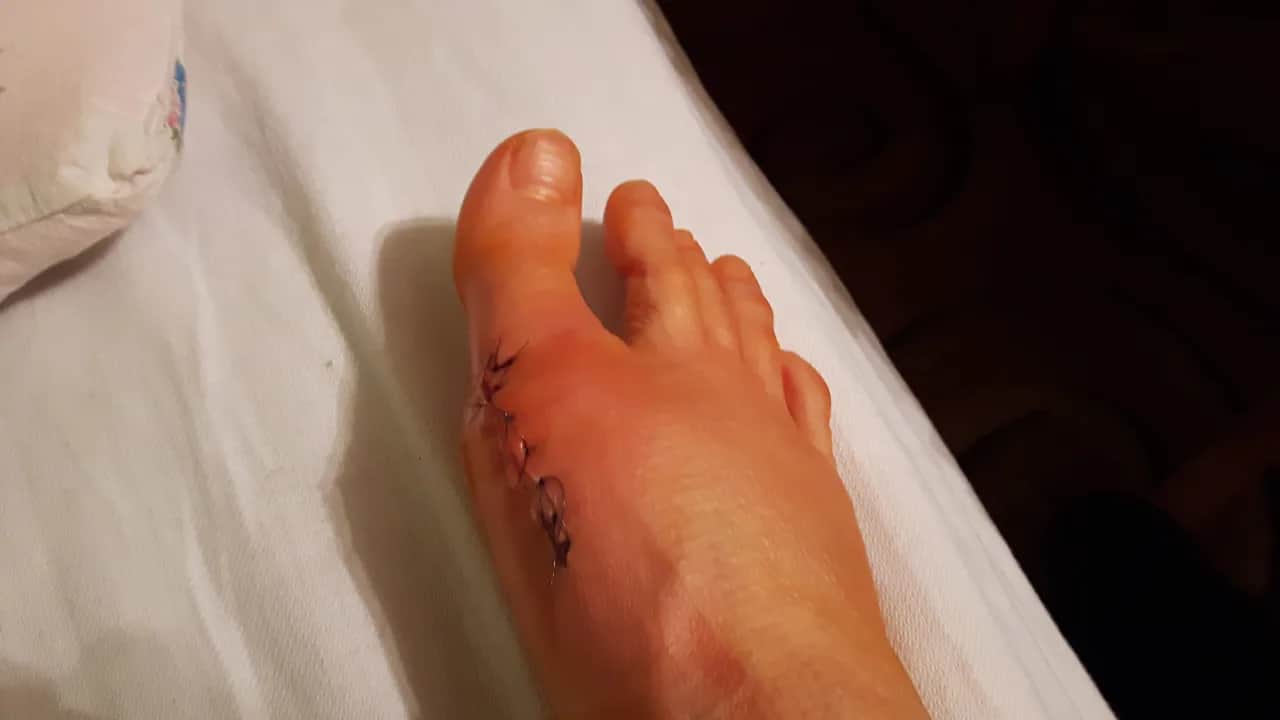 Jak zrobić opatrunek po operacji haluksa, aby uniknąć komplikacji