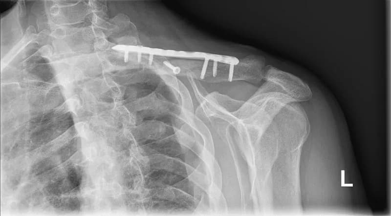 Ile trwa rehabilitacja po złamaniu obojczyka i jak ją przyspieszyć?