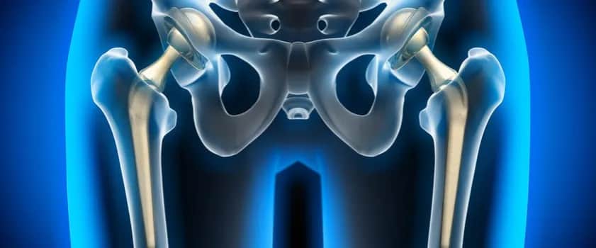 Ból stawu biodrowego objawy: Jak rozpoznać i złagodzić dolegliwości