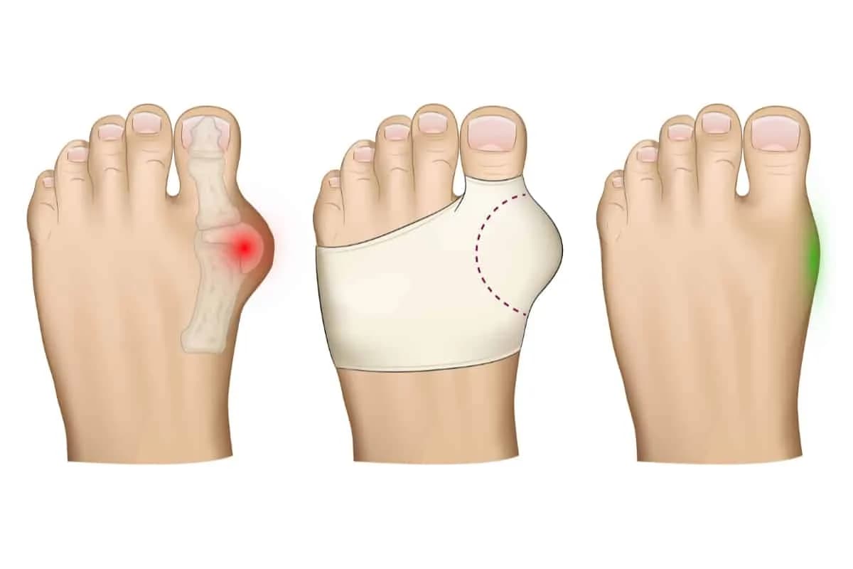 Czy haluksy odrastają? Poznaj ryzyko nawrotu i jak go uniknąć